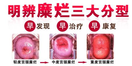 宫颈糜烂