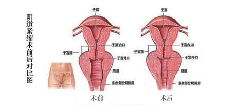 阴道紧缩术前术后对比图