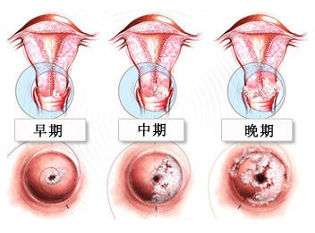 宫颈癌筛查